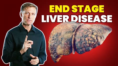<b>Liver</b> disease refers to several different conditions that cause harm to your <b>liver</b>. . What are the signs of dying from cirrhosis of the liver